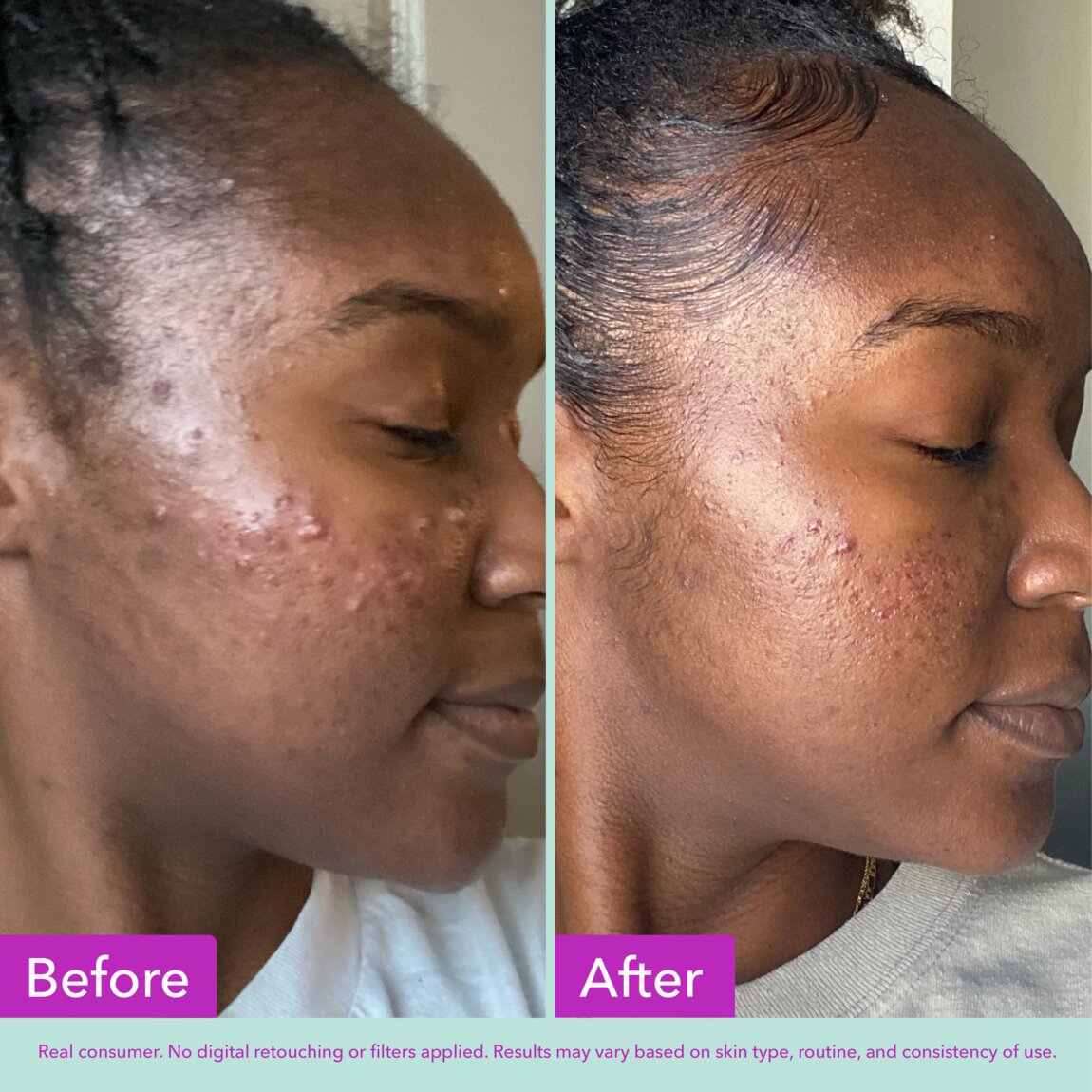 acne-foaming-cleanser-j1 zb_p.jpg